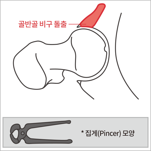 고관절