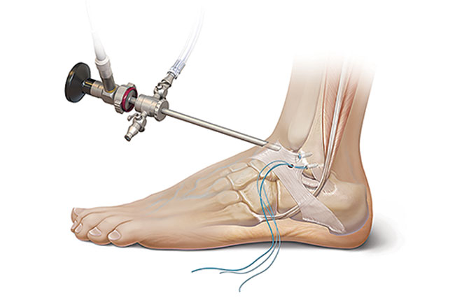 발목인대봉합술