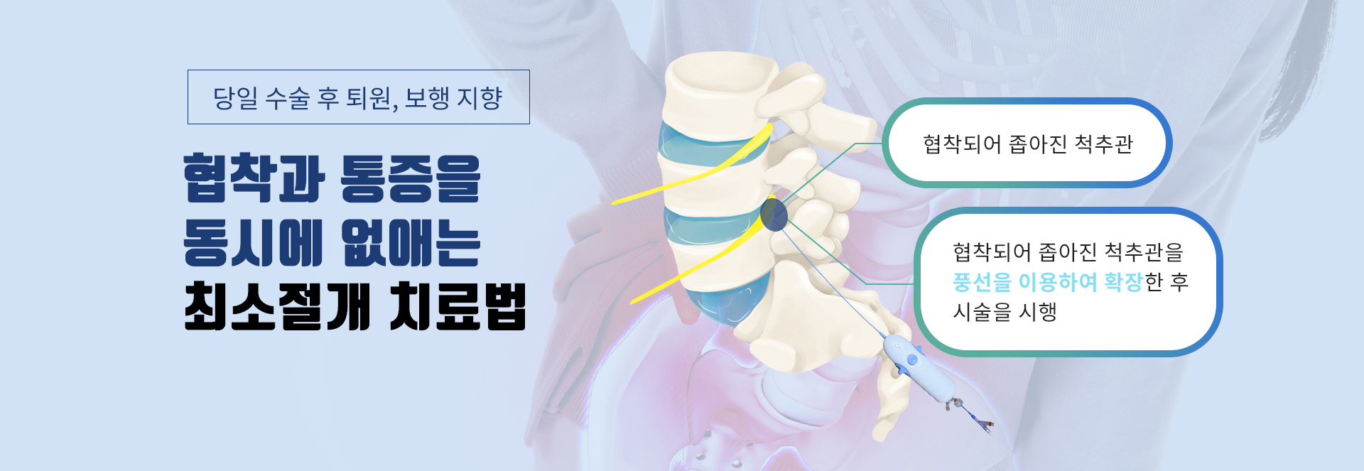 풍선확장신경성형술