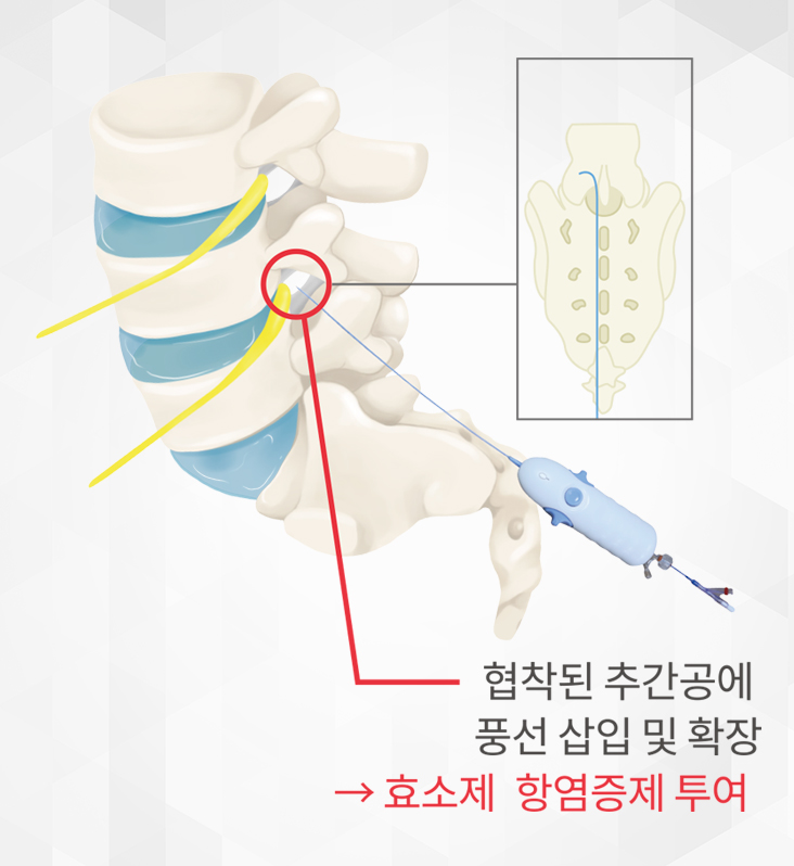 풍선확장신경성형술