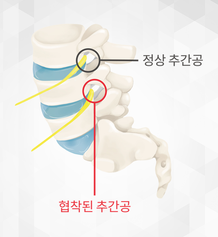 풍선확장신경성형술