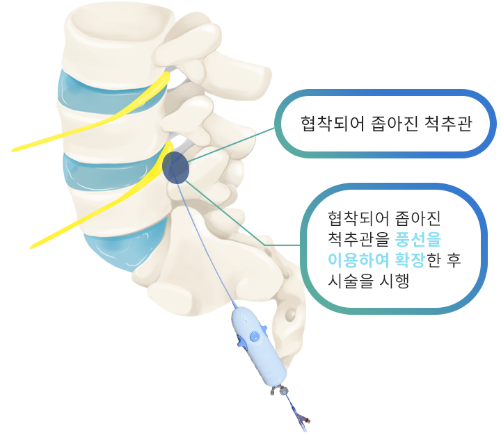 풍선확장신경성형술