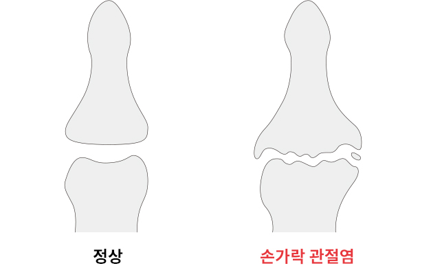 손가락퇴행성관절염