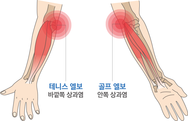 결절종