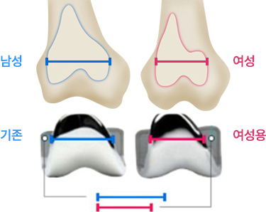 좌식생활에 적합한 한국형 인공관절
