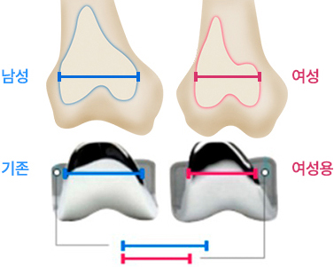 좌식생활에 적합한 한국형 인공관절