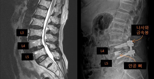 척추내시경 유합술 사례