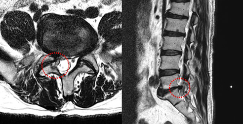 척추내시경 유합술 사례