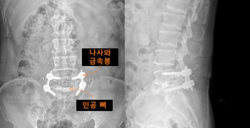 척추내시경 유합술 사례