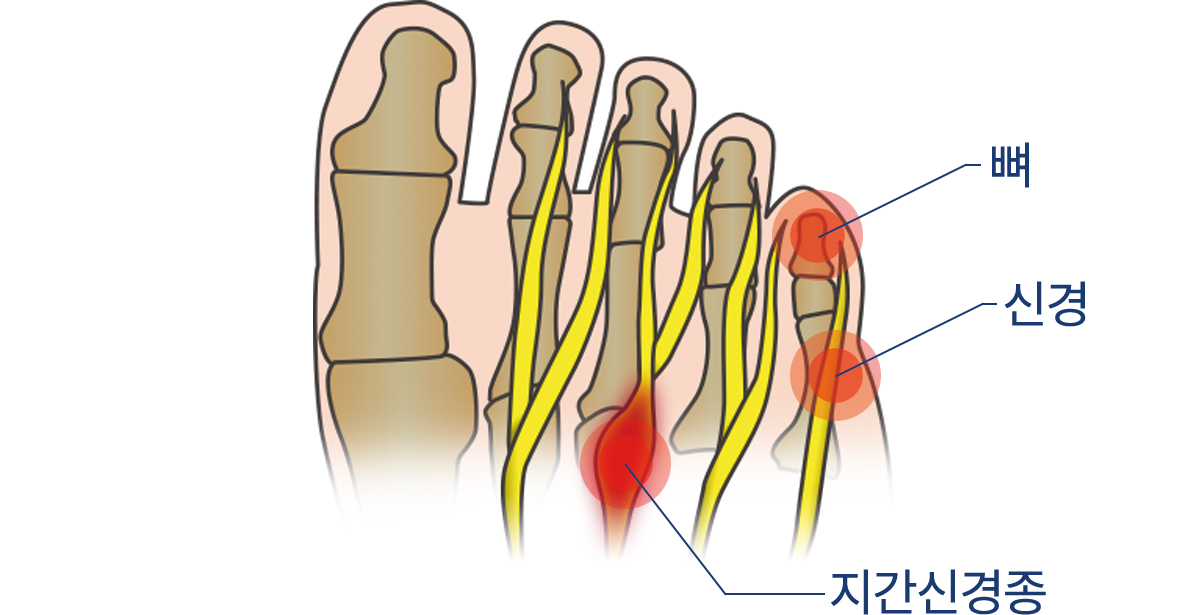 깔창치료