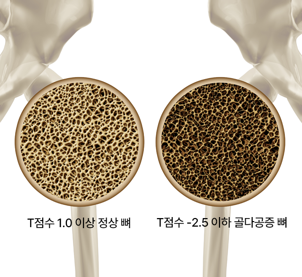 골다공증 골절