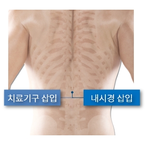 허리내시경