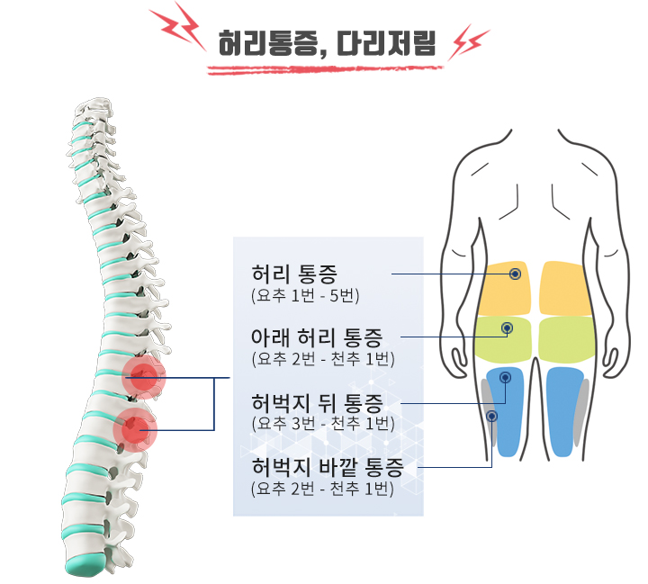 척추관협착증