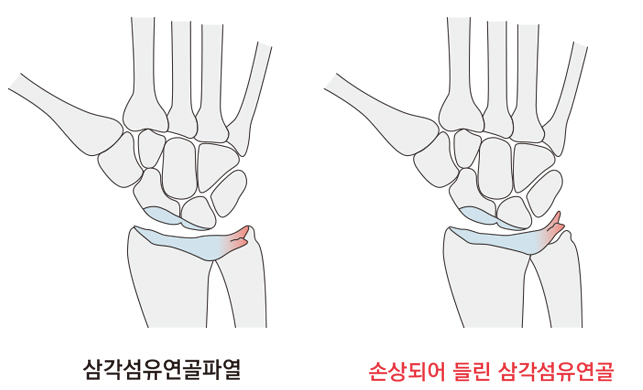 삼각섬유연골