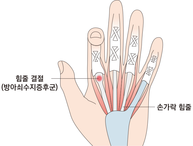 방아쇠수지증