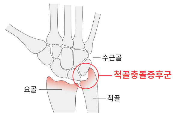 손목척골충돌증후군​